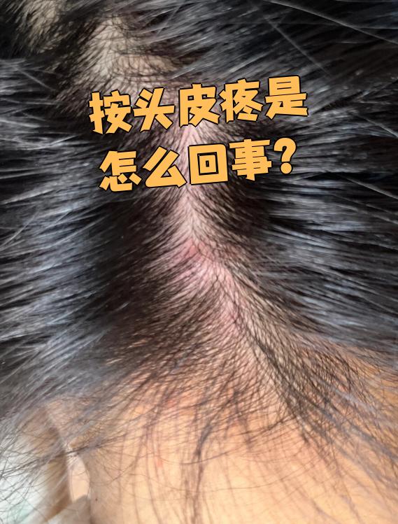 头皮痛是什么原因