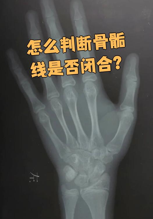 骨头闭合了还能长高吗
