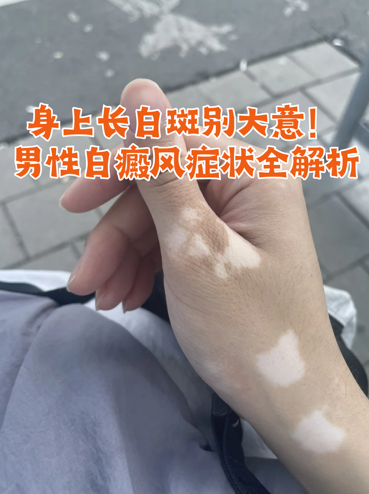 身上有块白斑是什么