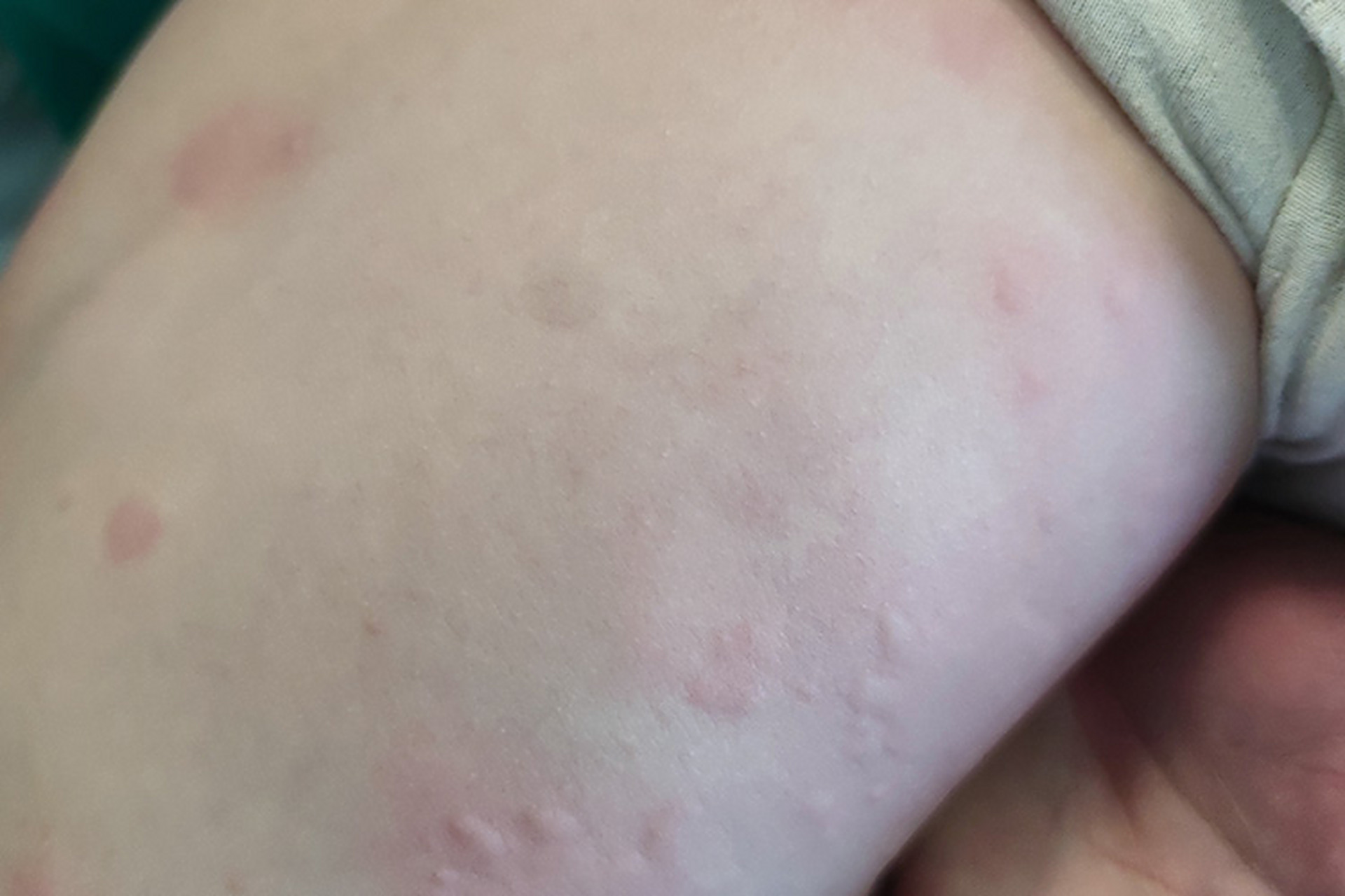 儿童过敏性荨麻疹是什么