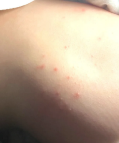 儿童过敏性荨麻疹是什么