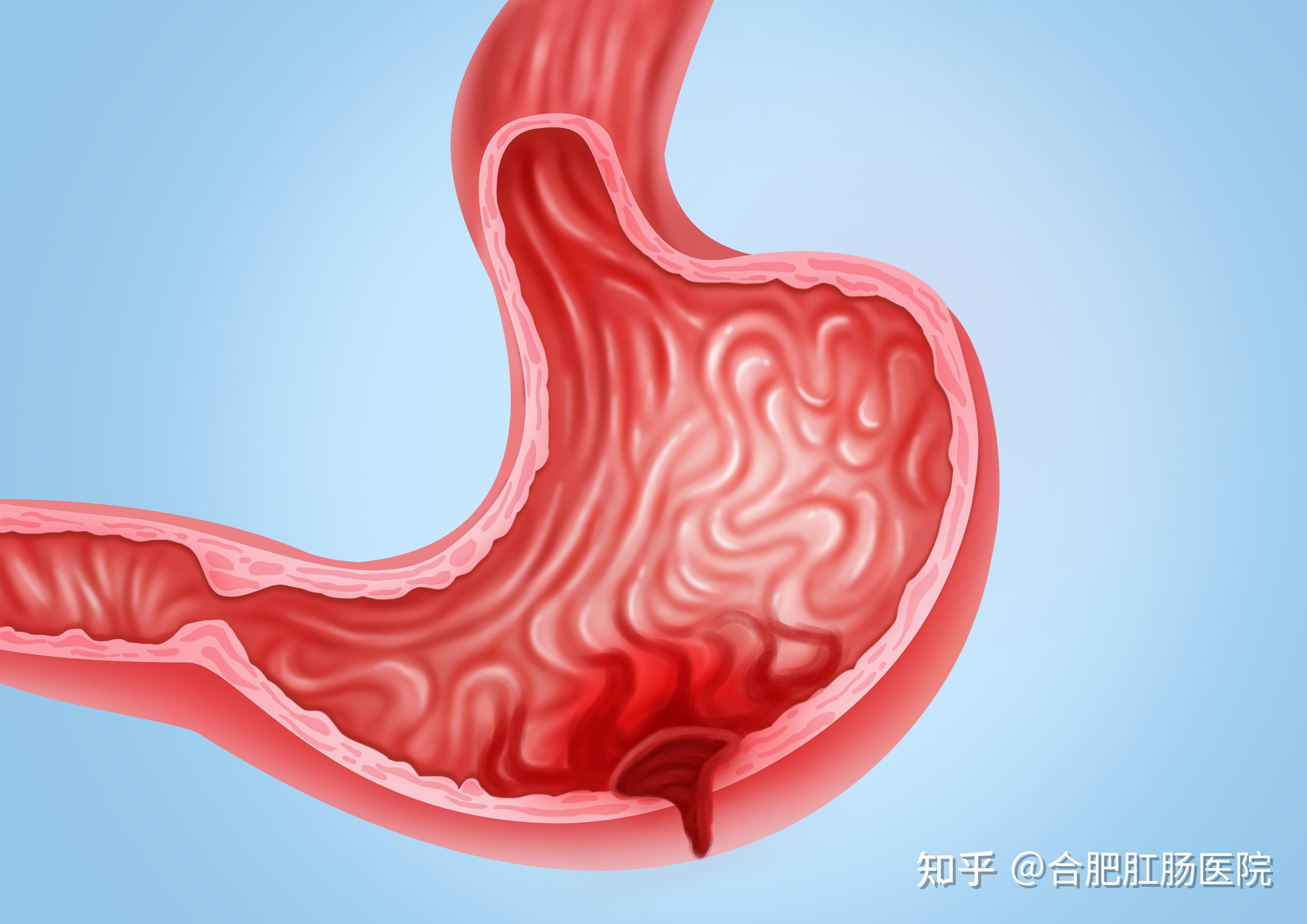 胃穿孔是什么原因