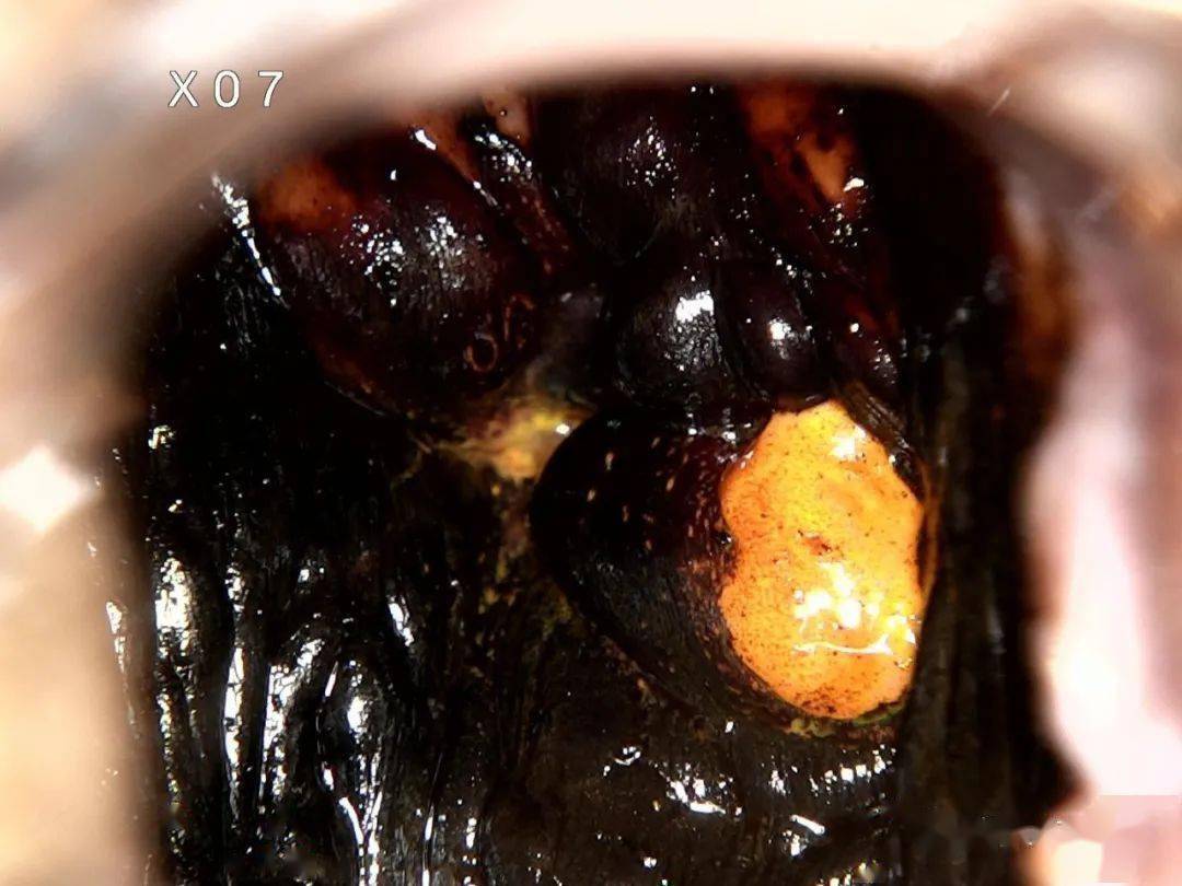 阴道镜活检是什么