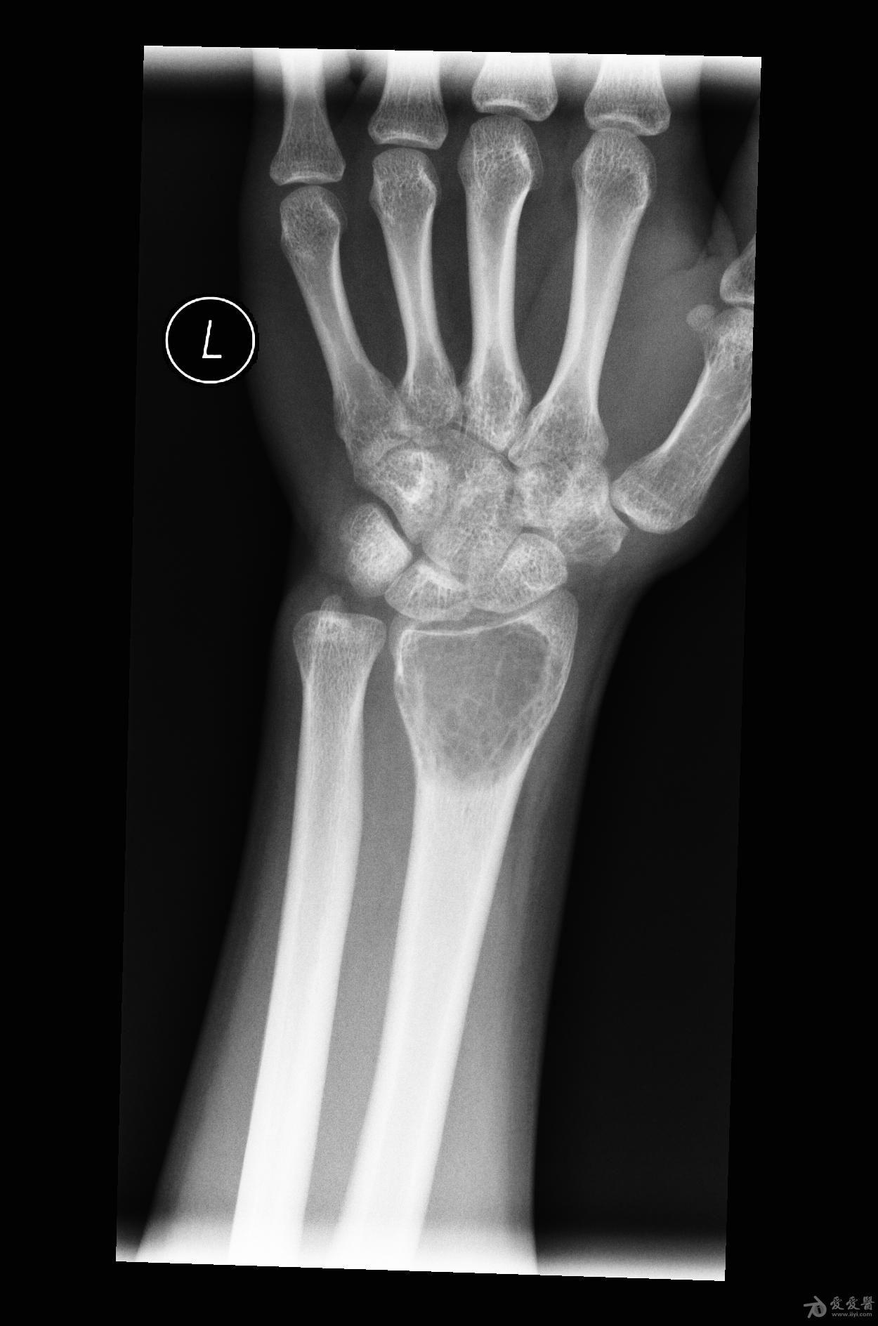 骨巨细胞瘤的X线表现