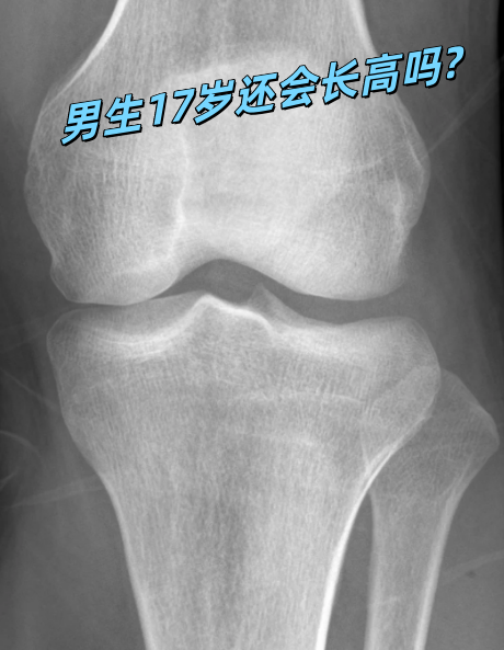 17岁还可以长高吗?