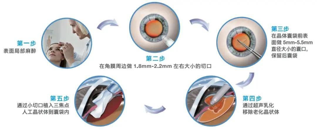 什么是白内障手术?