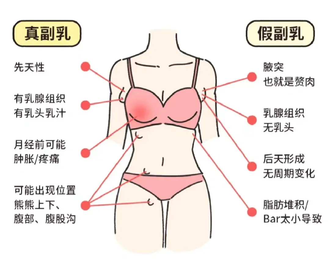 假副乳和真副乳的区别