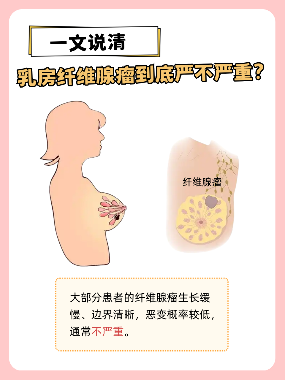 乳腺纤维瘤癌变的几率多大