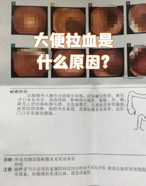 肠癌早期大便会拉血吗