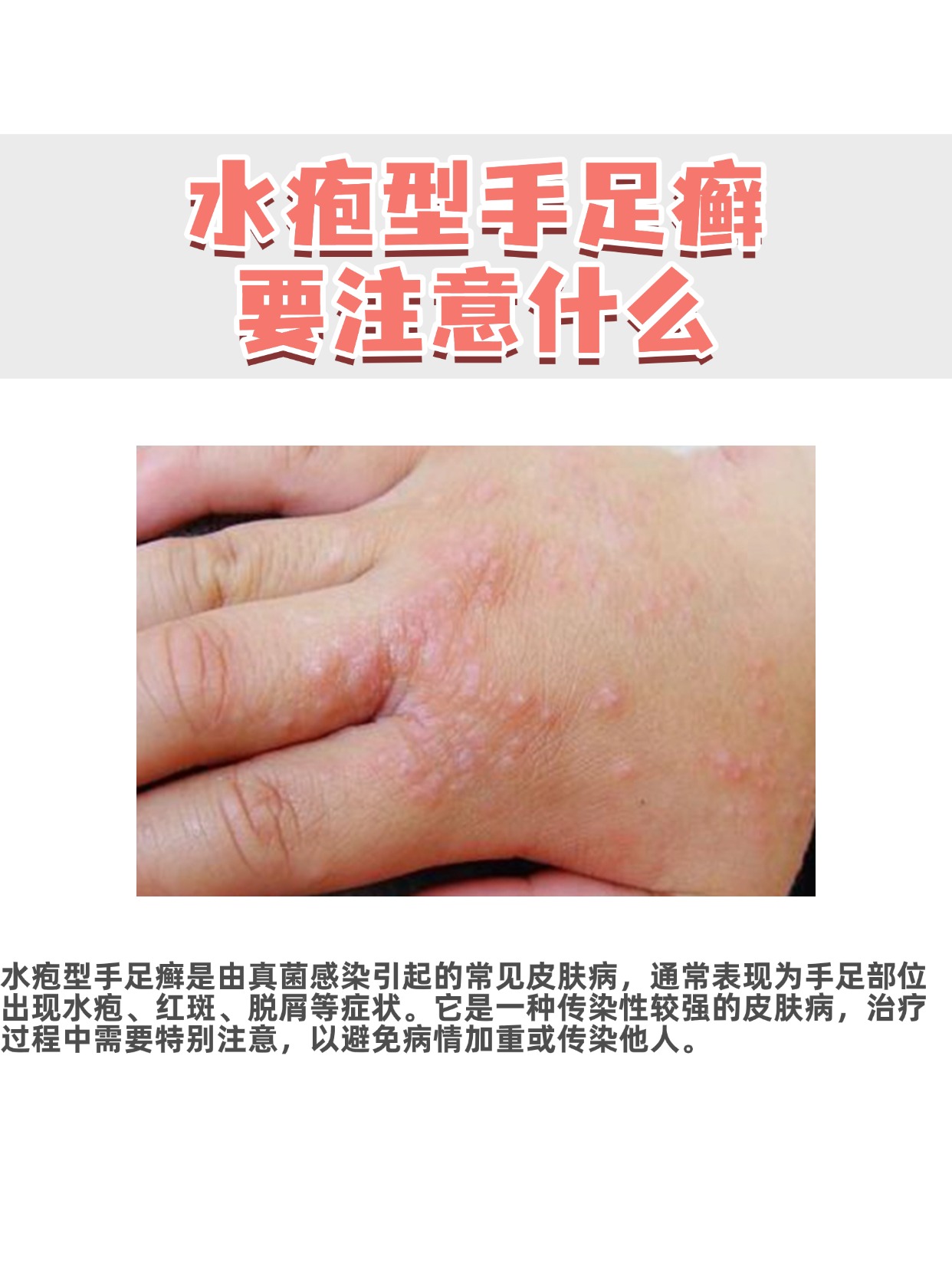 水疱型脚气的症状