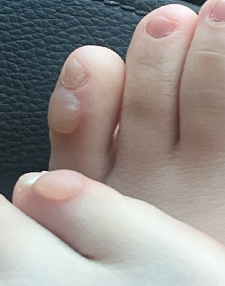 水疱型脚气的症状