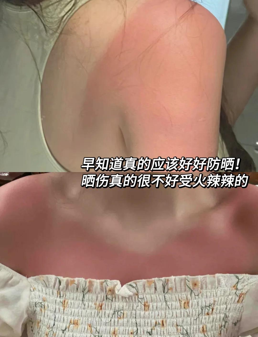 脸被晒伤了怎么办