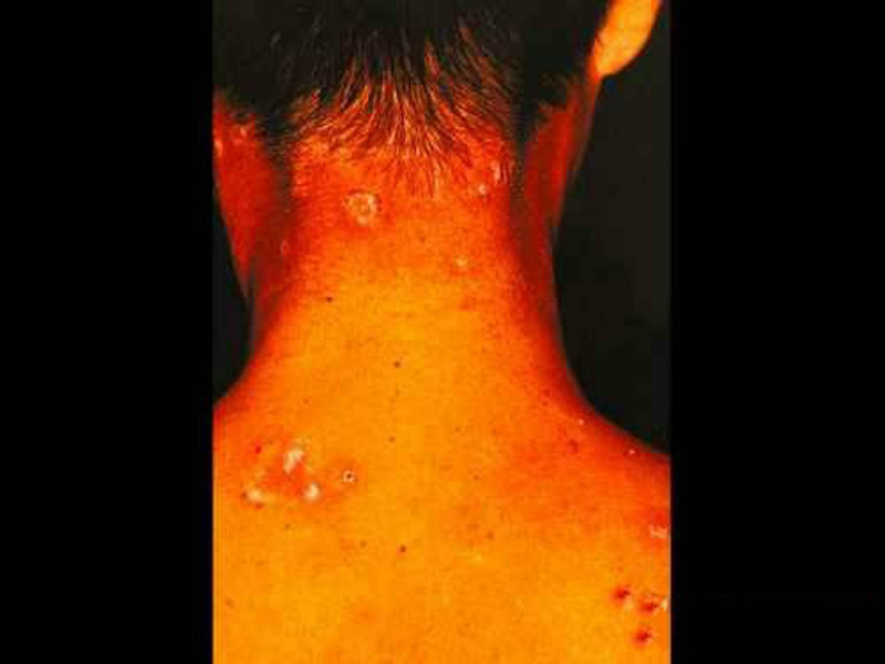 白色念珠菌感染症状有哪些