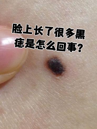 脸上为什么突然长了很多的痣?