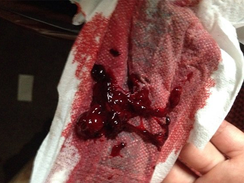 子宫内膜癌早期出血什么样