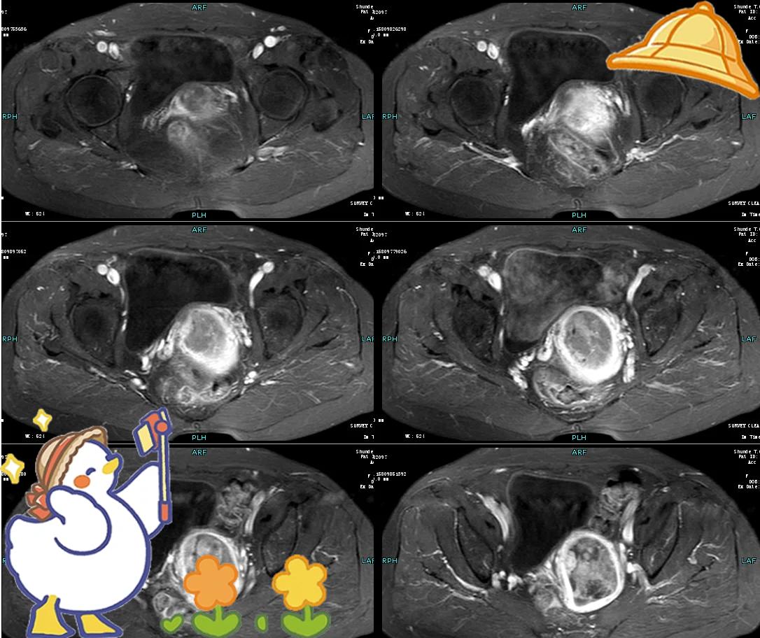 子宫内膜癌早期出血什么样