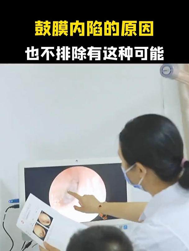 耳膜内陷一般多久能好
