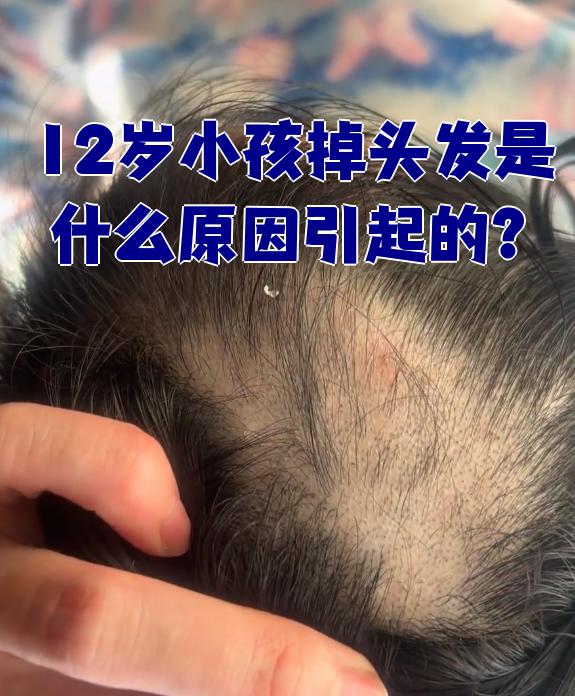 小孩掉头发是什么原因