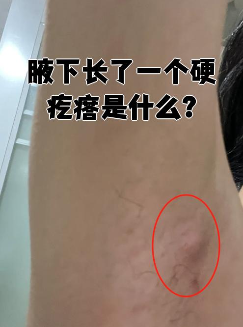 腋窝下面红肿疼痛