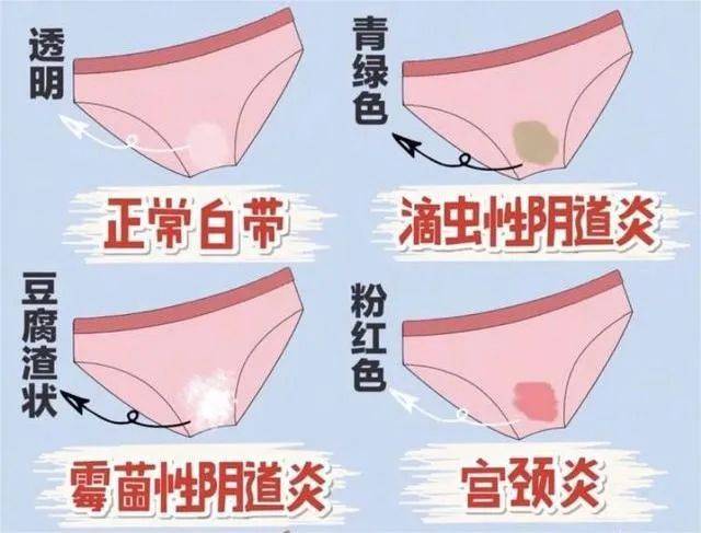 老年性阴道炎是什么