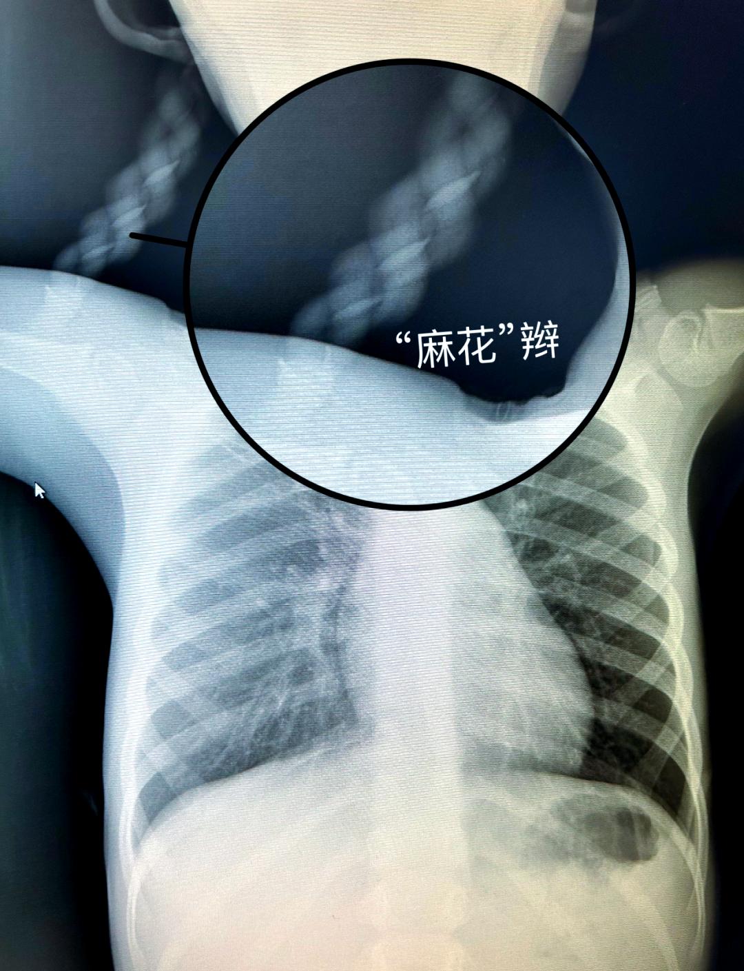 拍胸片的影响和危害