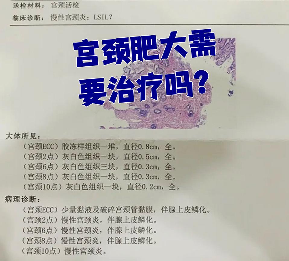 子宫肥大需要治疗吗?
