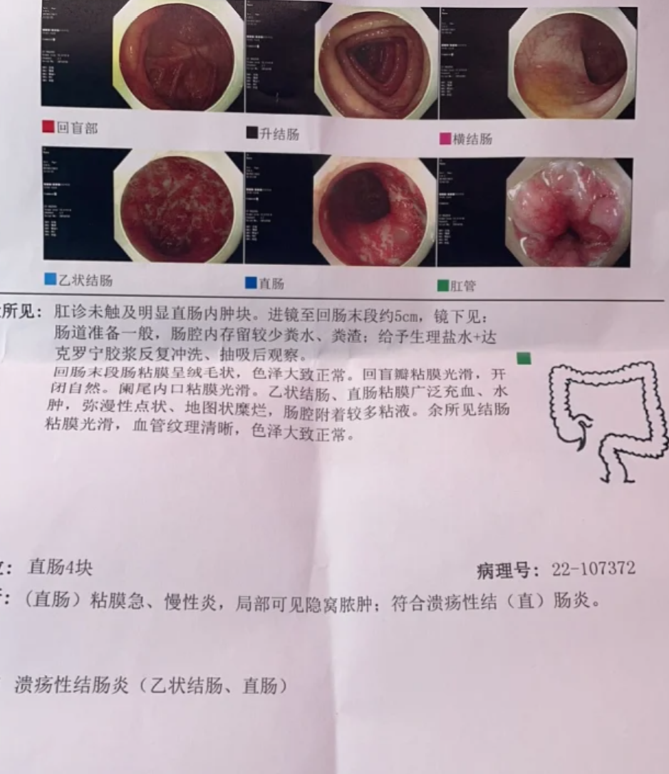 为什么解大便会出血?
