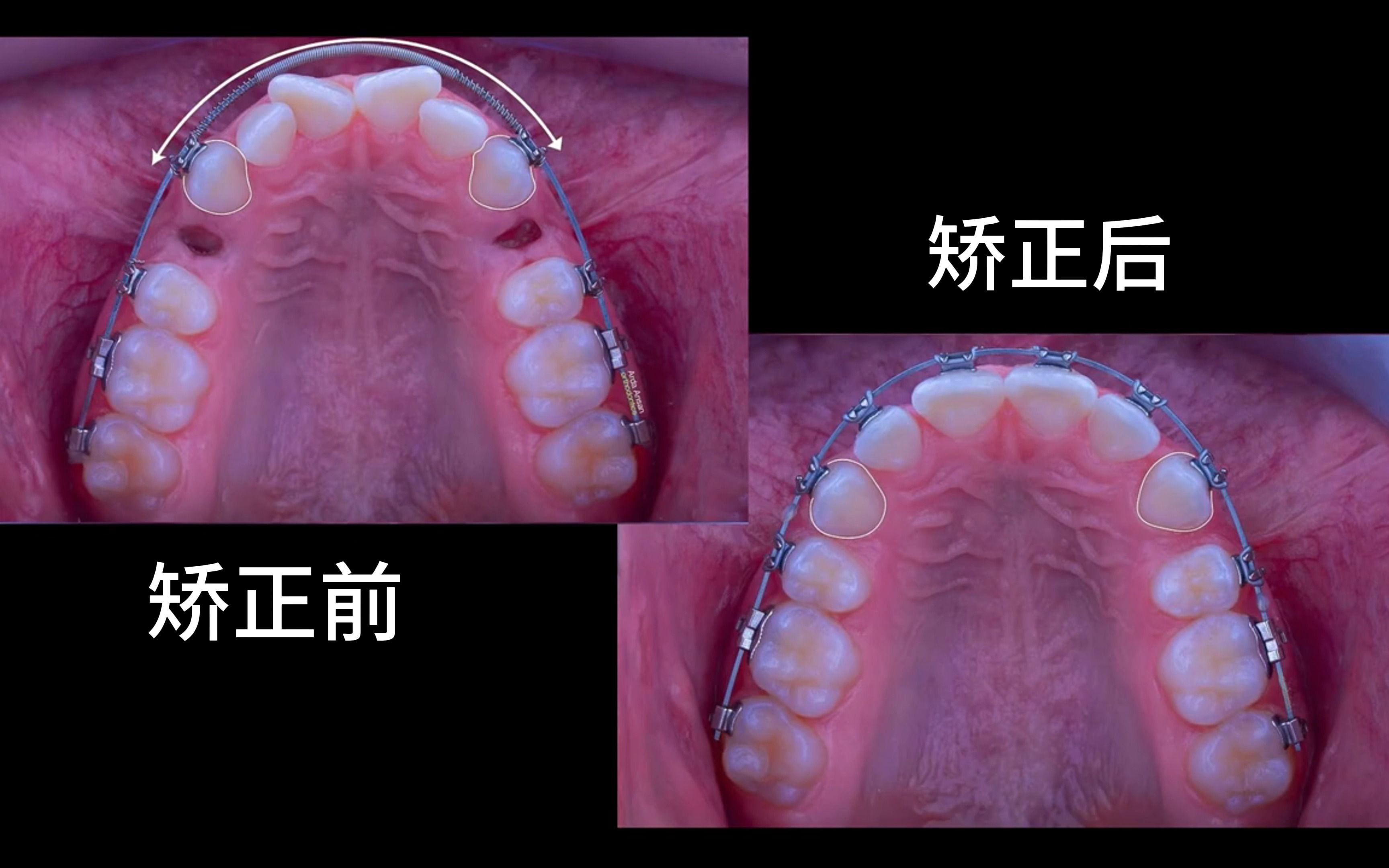 什么是牙齿正畸