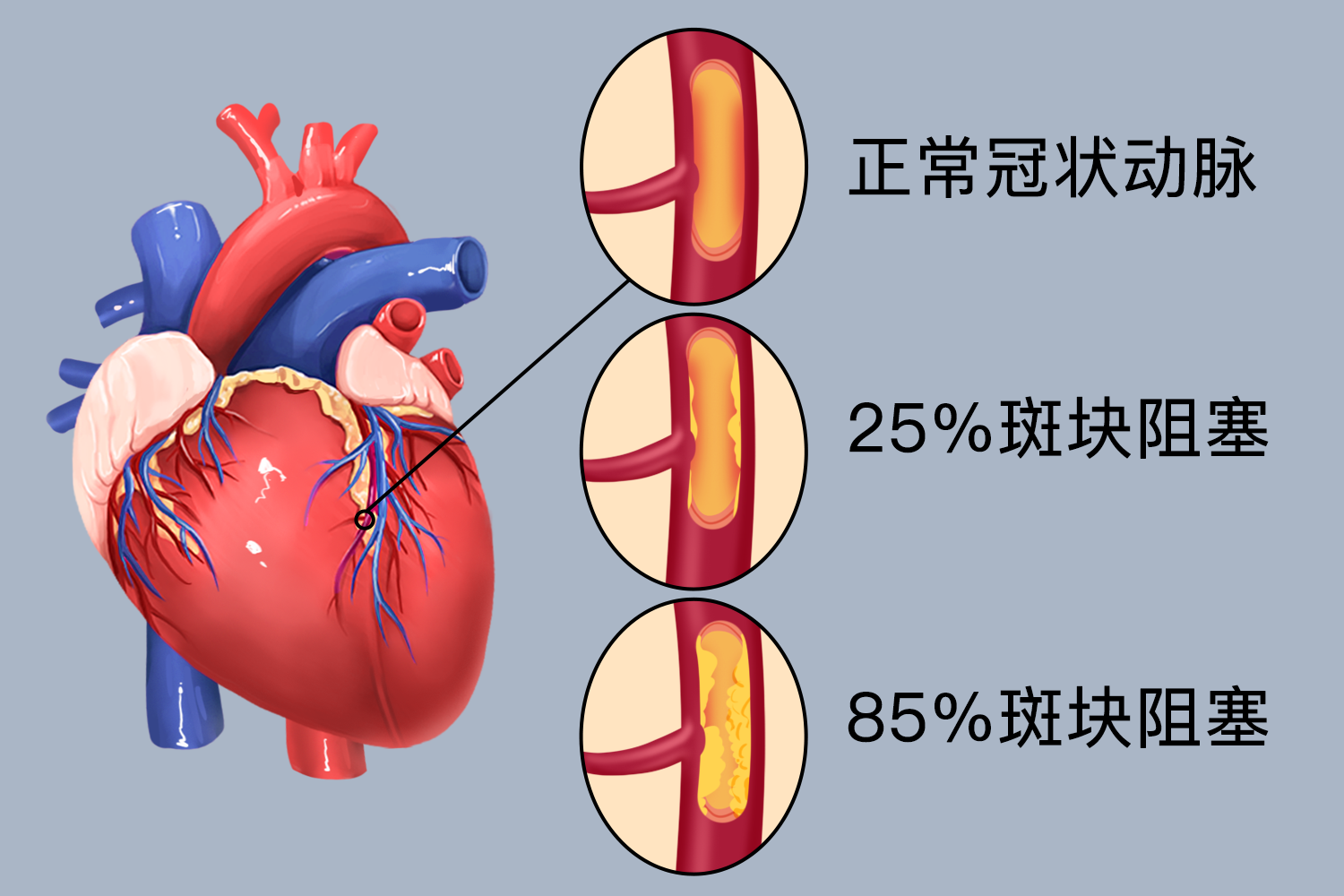 心血管疾病有哪几类