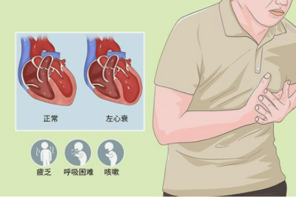 左心衰竭的临床表现有哪些