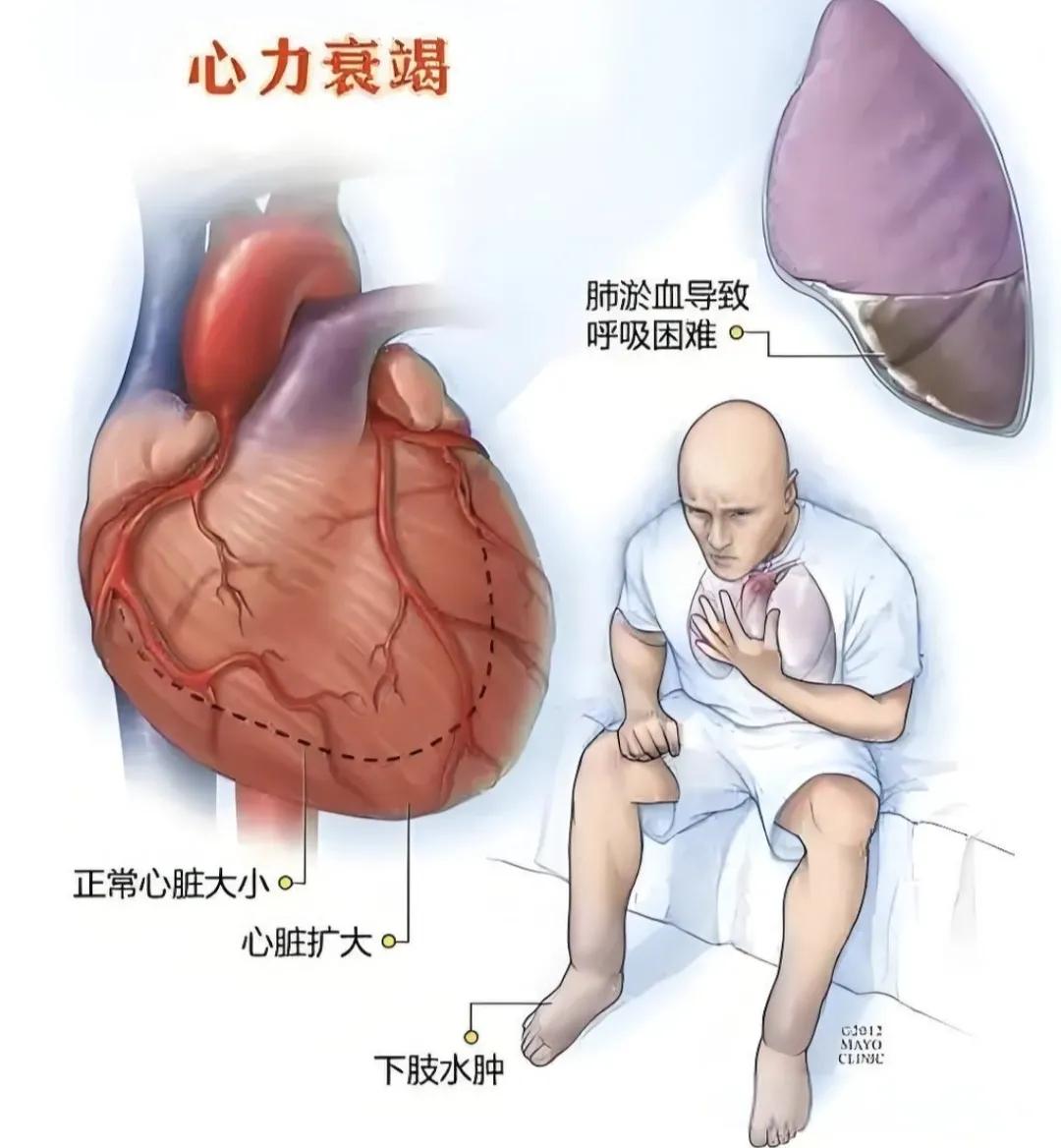 左心衰竭的临床表现有哪些