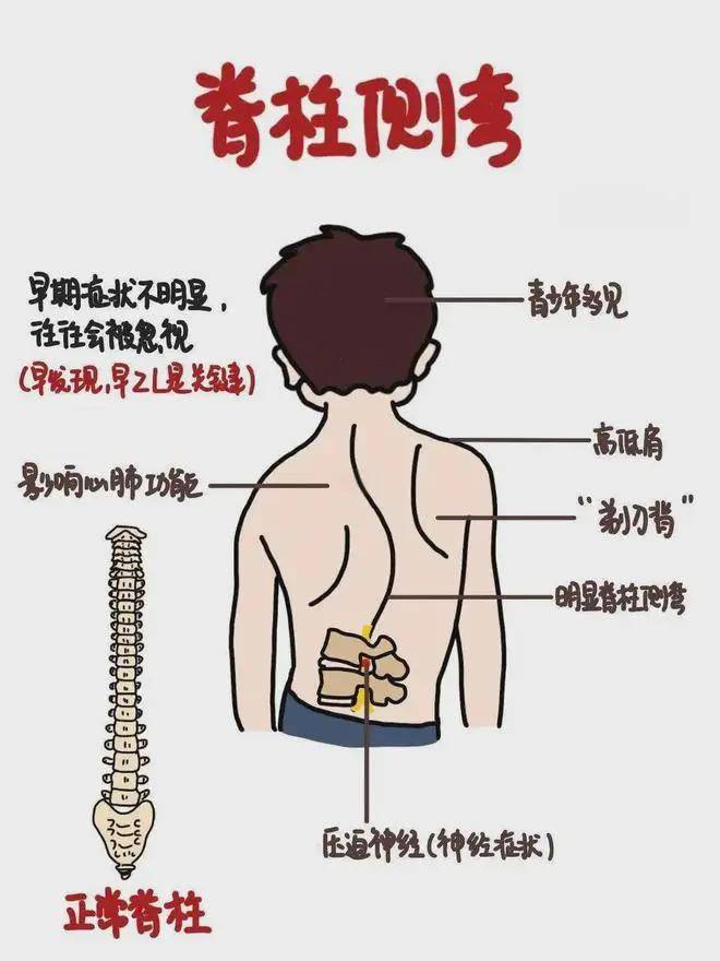 急性脊髓炎的症状