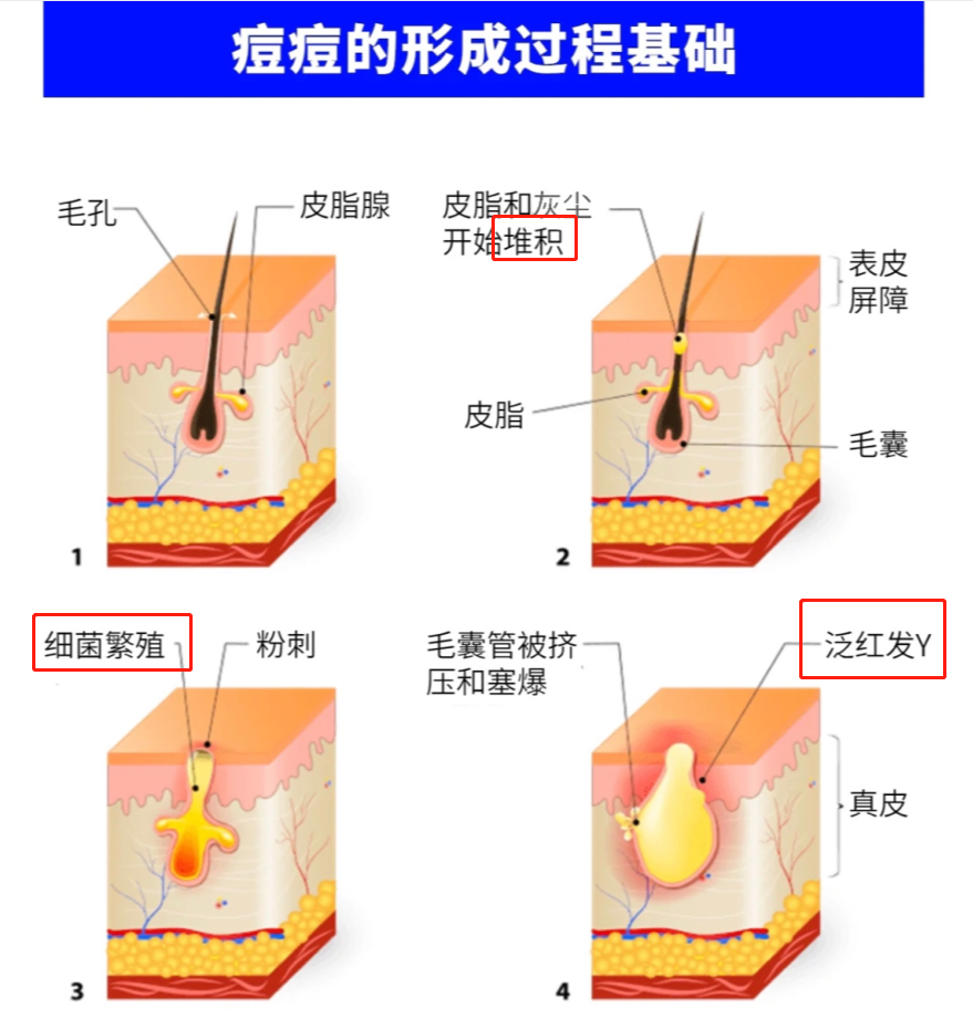 痤疮形成的原因