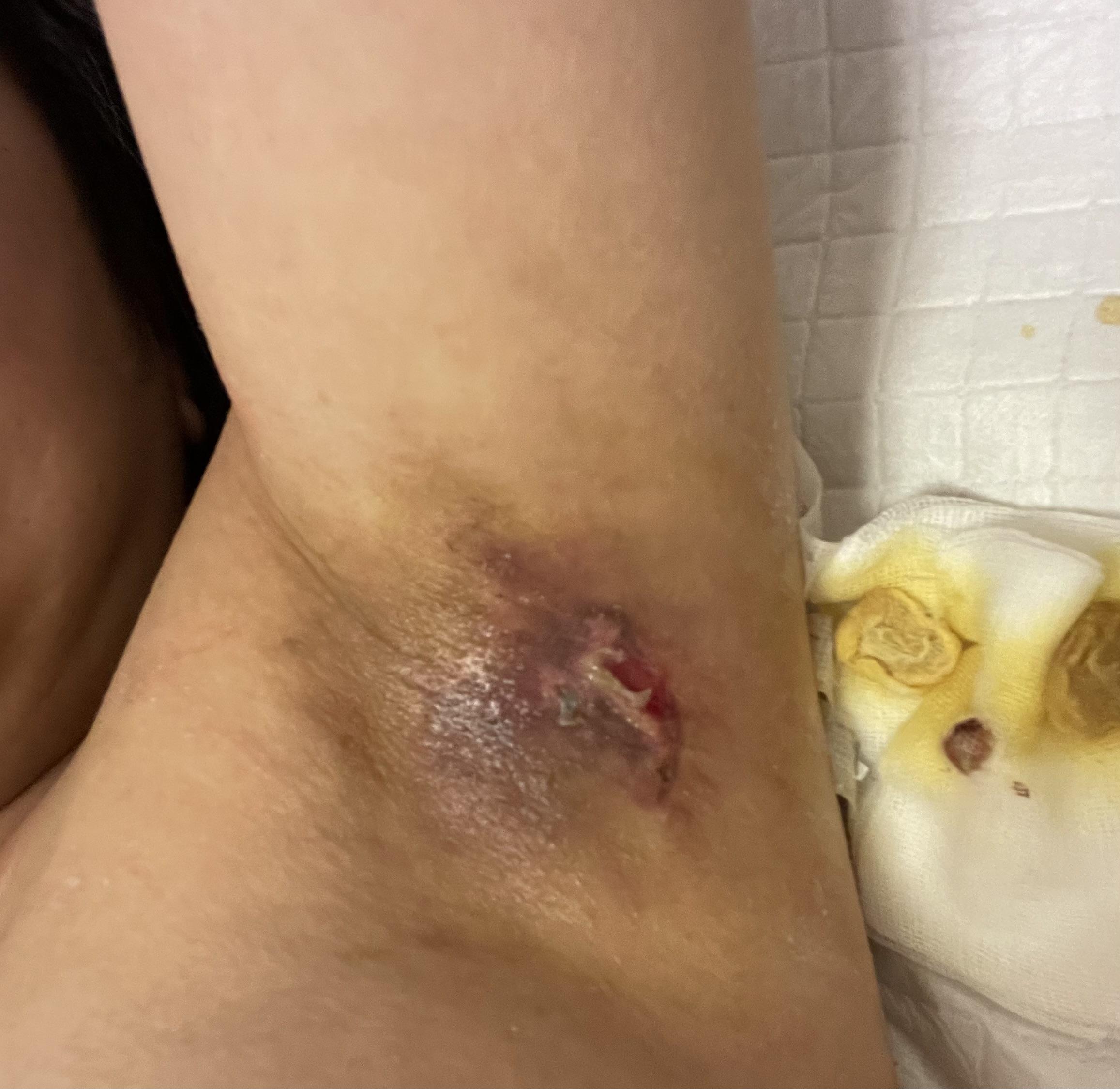 腋臭微创手术是什么意思?求解