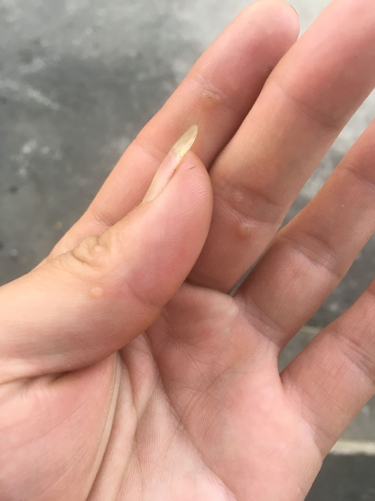 手指上起小疙瘩,不痒像小米粒大小