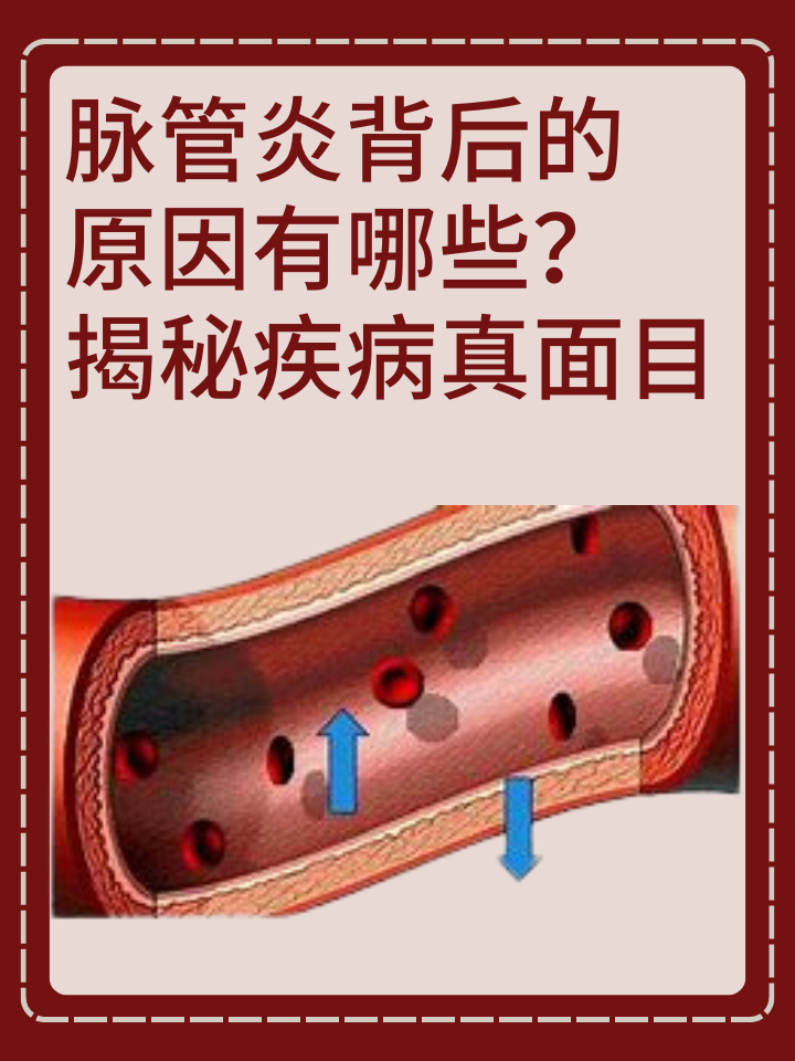 脉管炎好治吗