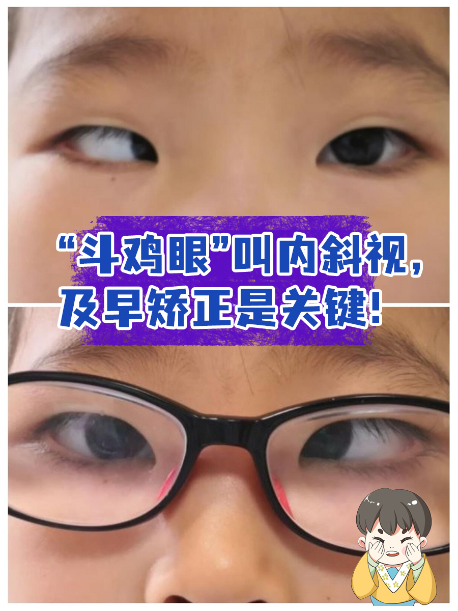 眼睛斜视的原因