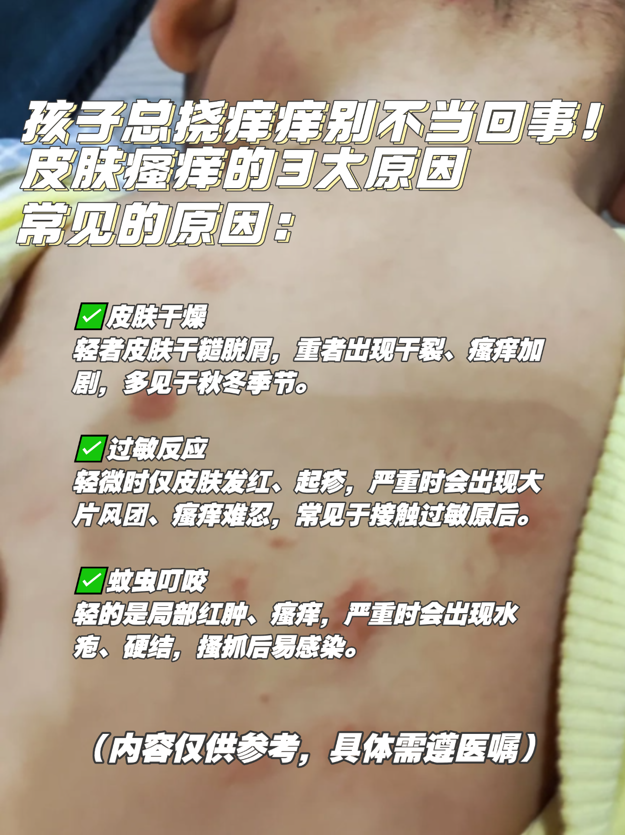 宝宝荨麻疹怎么办