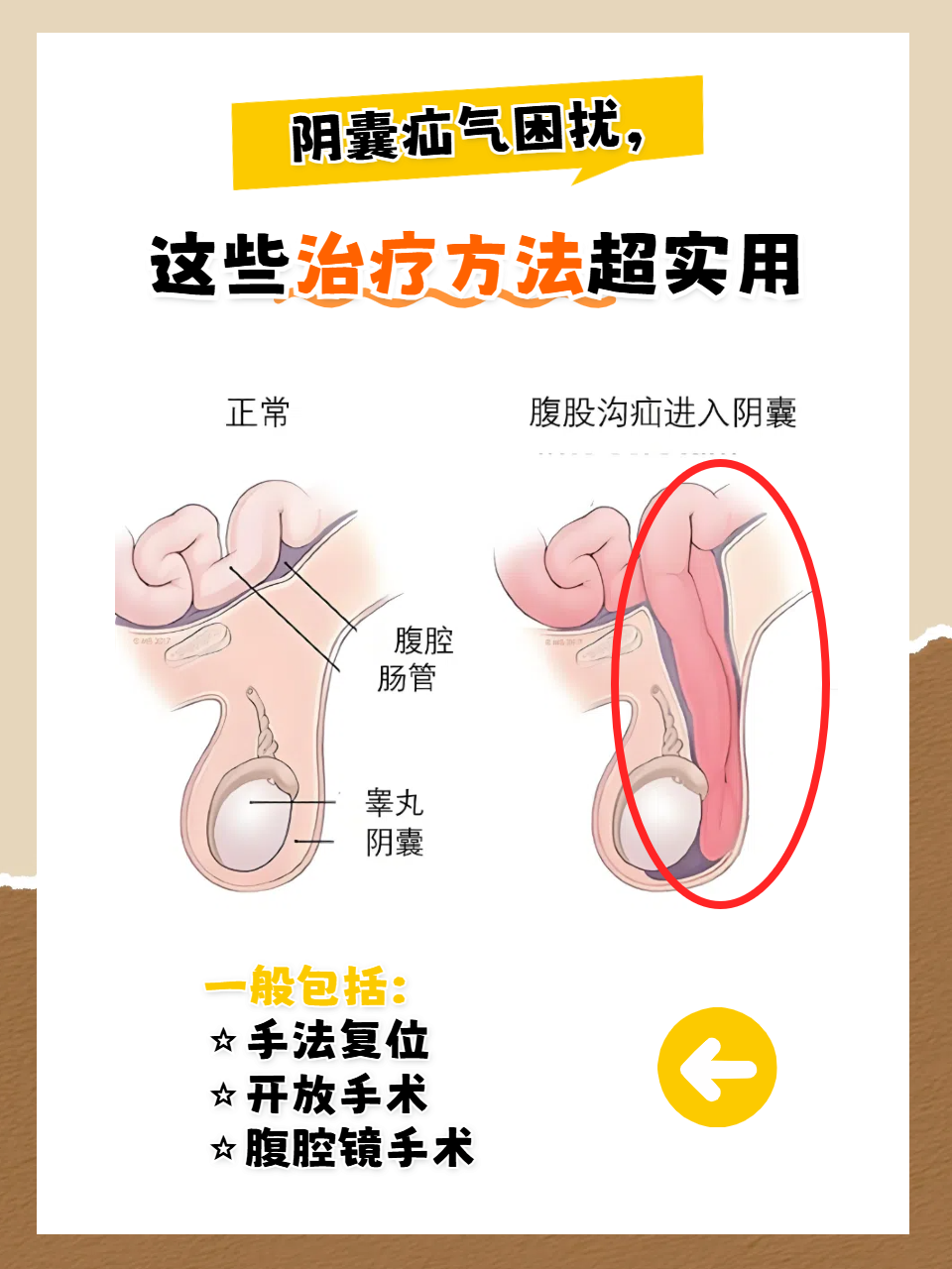 腹股沟疝修补手术方式