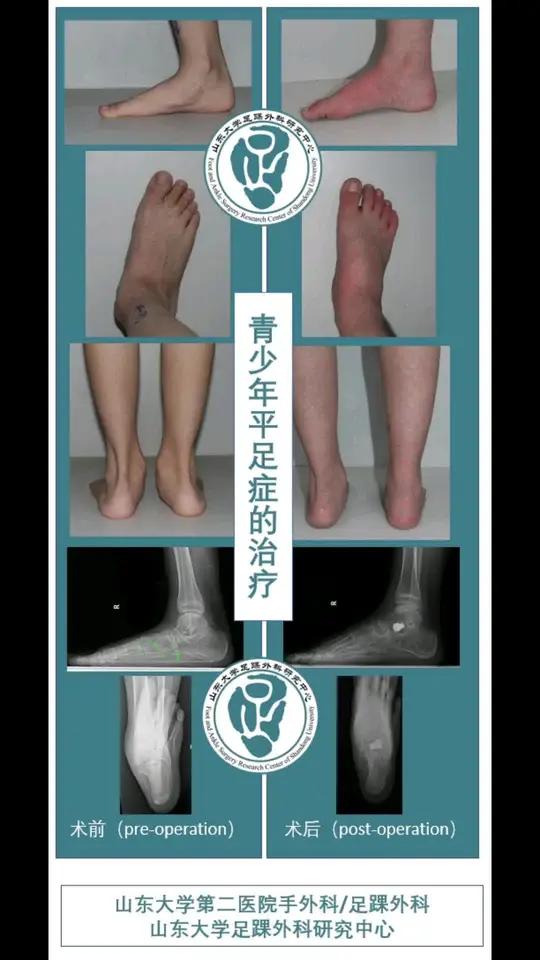 平足有什么危害