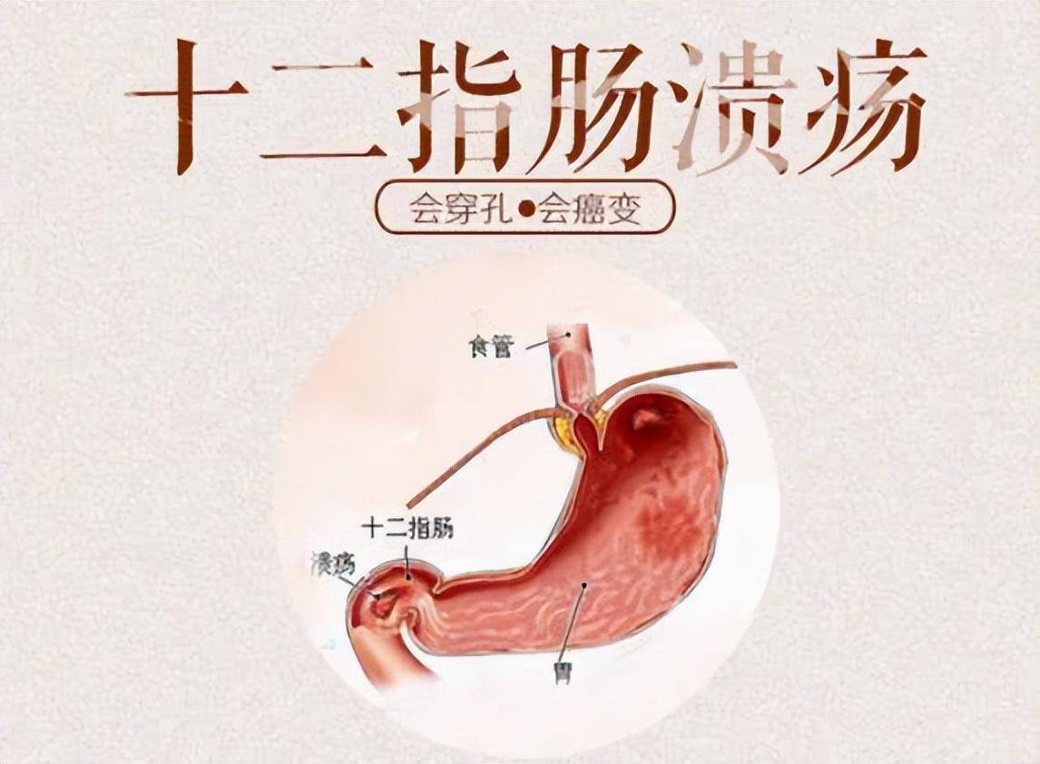 消化性溃疡是指什么