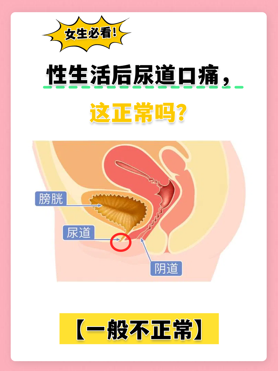 女性得尿道炎怎么治疗?