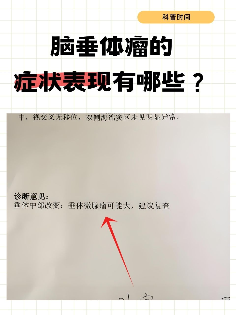 脑垂体囊肿