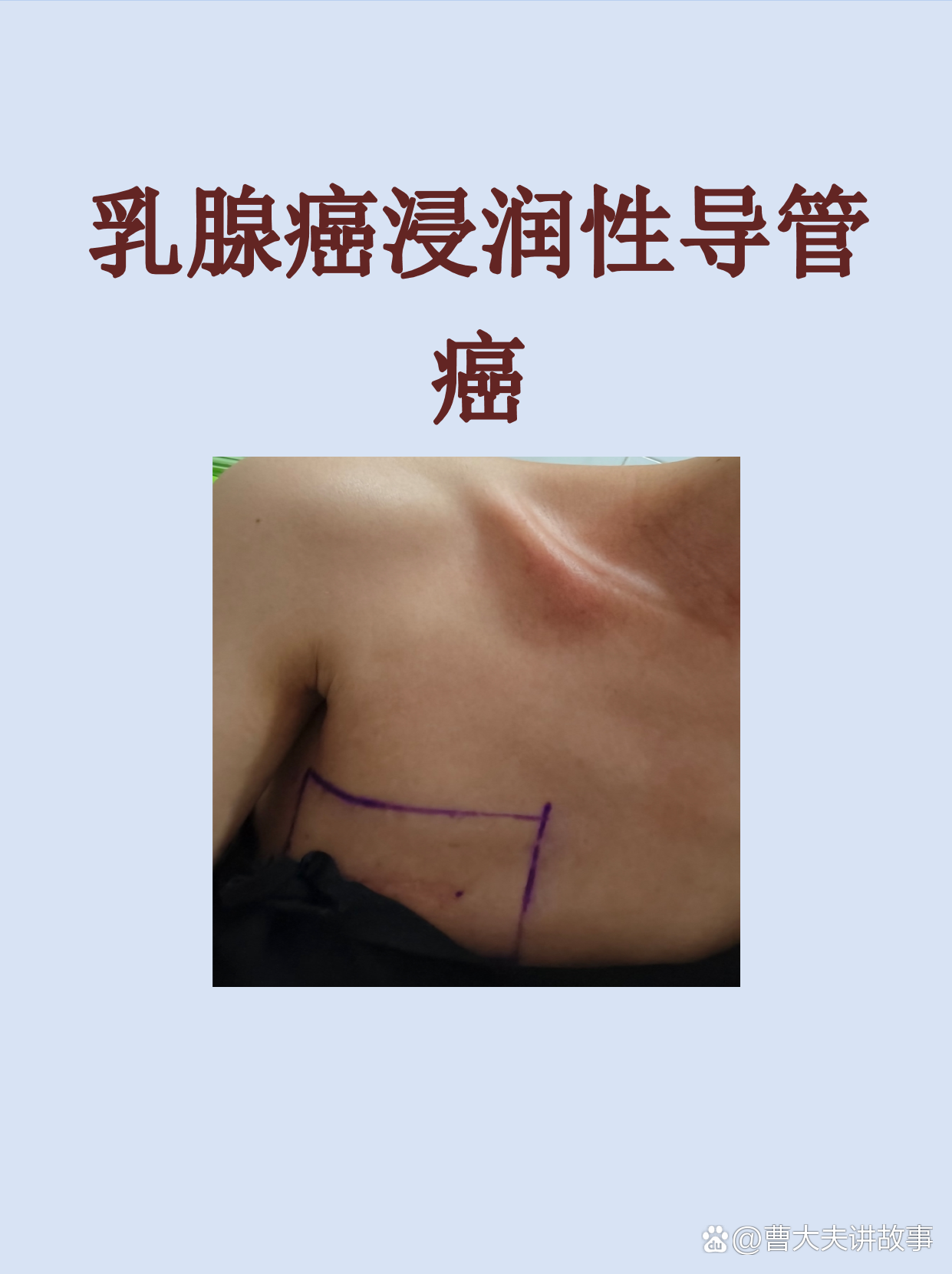 什么是乳腺导管癌