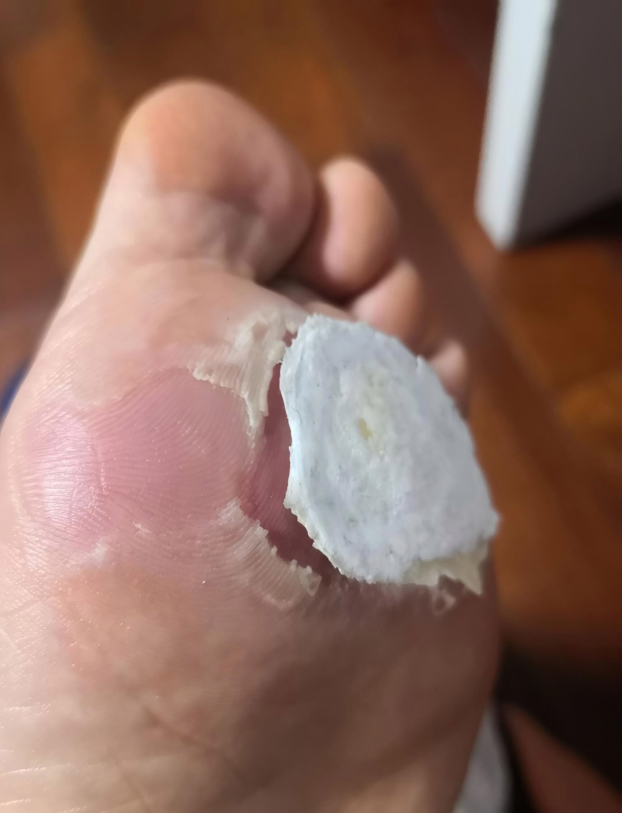 鸡尤泰治疗鸡眼好用么