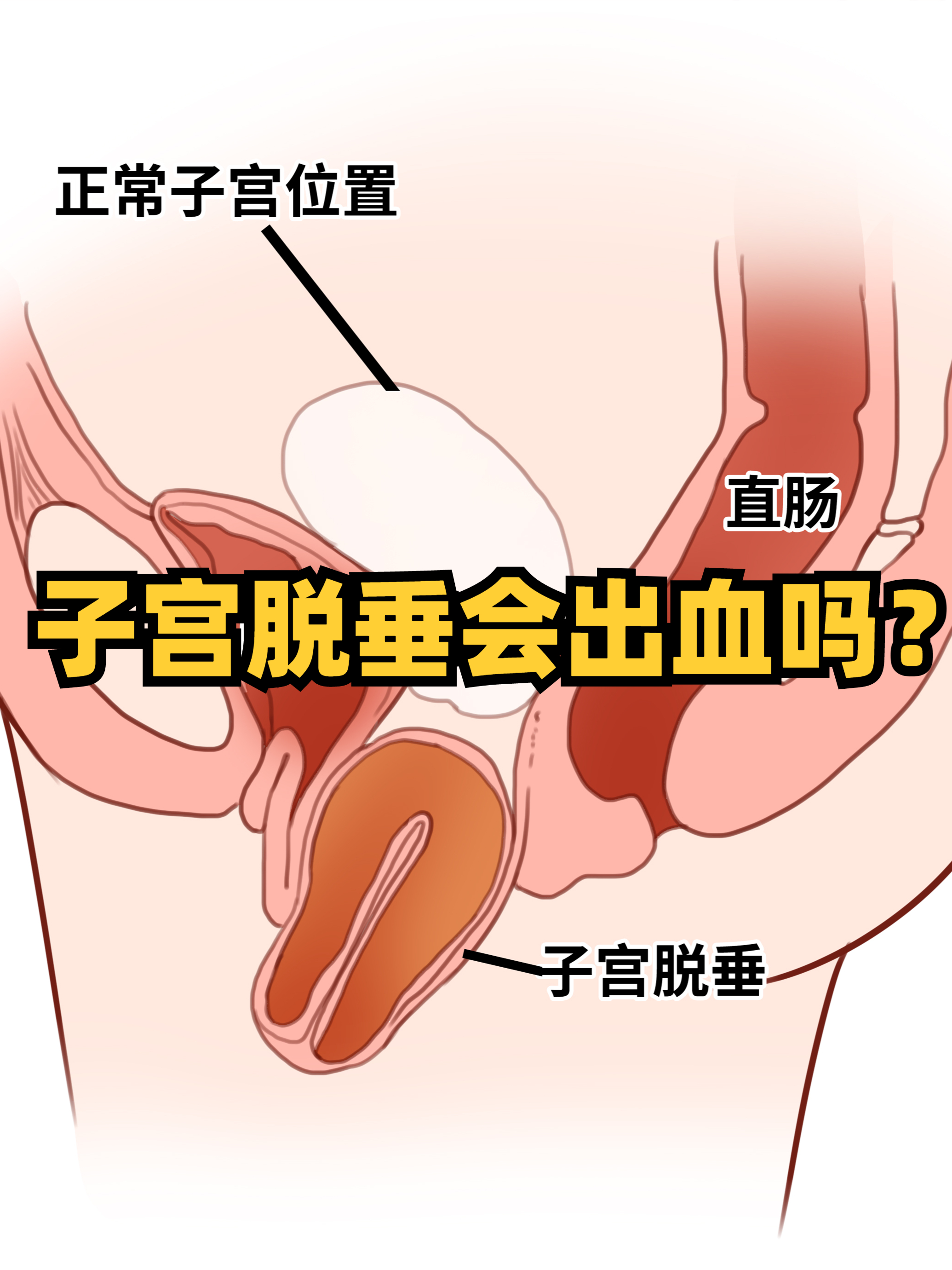 宫颈外翻是怎么引起的