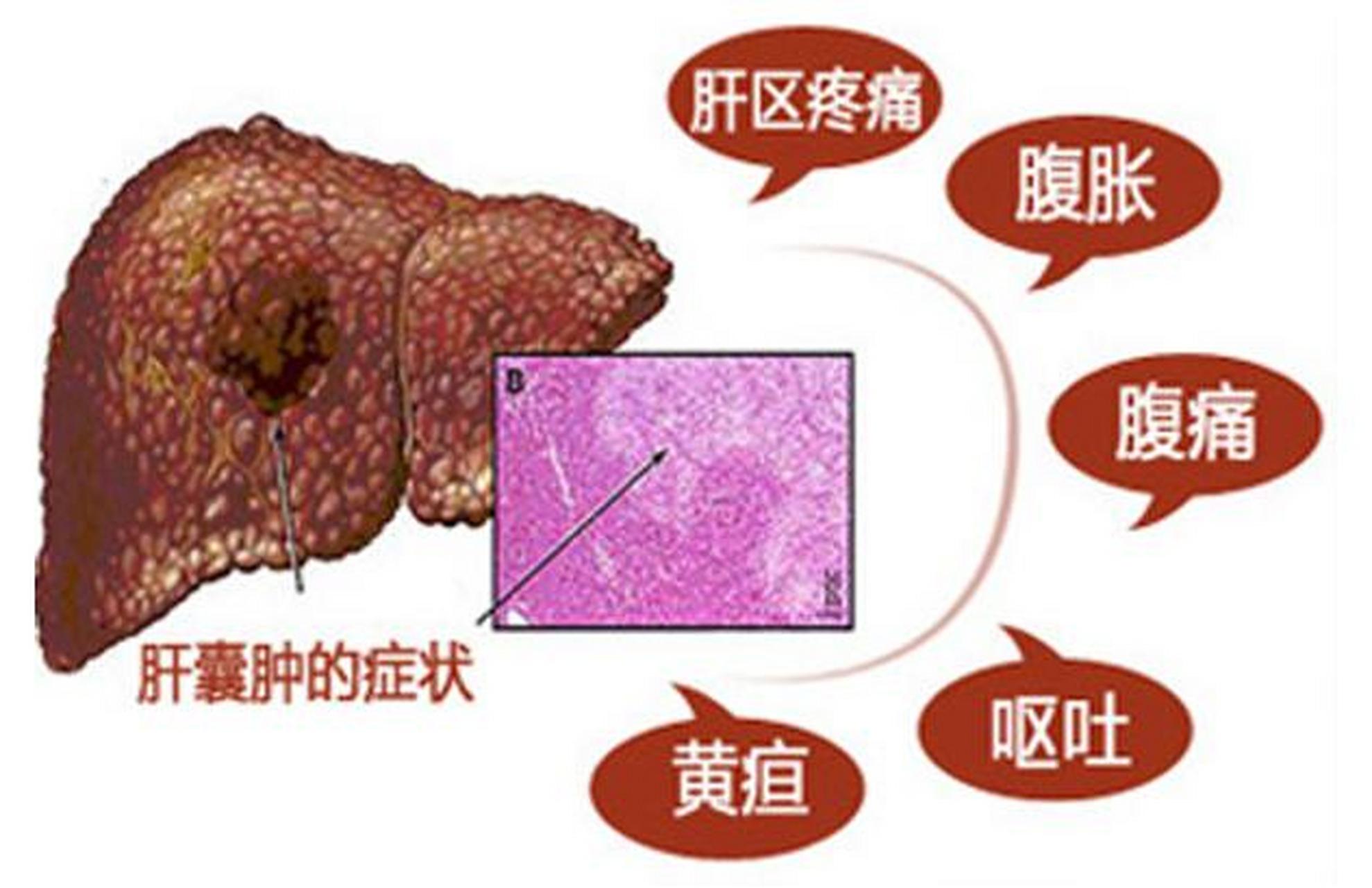 肝囊肿1010mm严重吗?