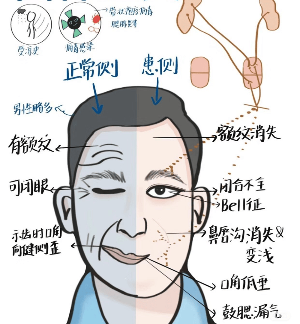 什么是周围性面瘫?