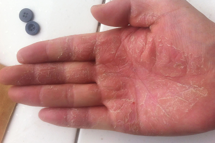 白血病都有什么症状?