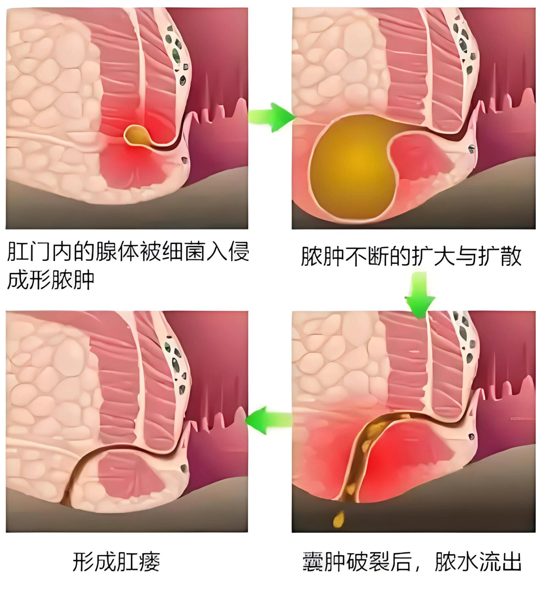 肛周脓肿根治术是怎么回事